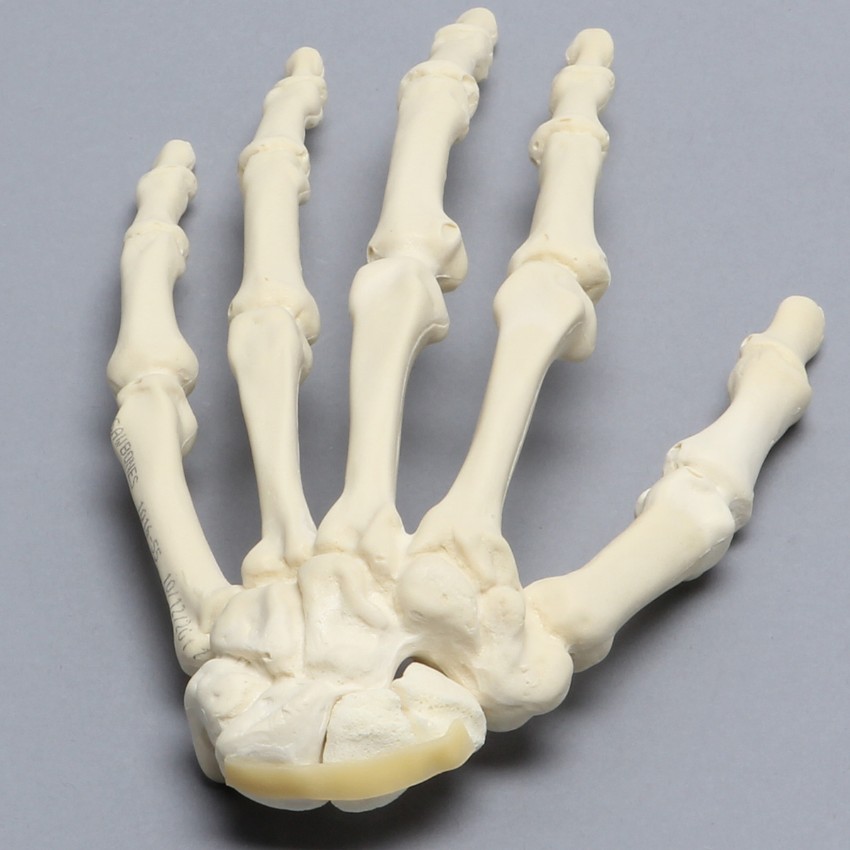Sawbones Mano con fractura de escafoides
