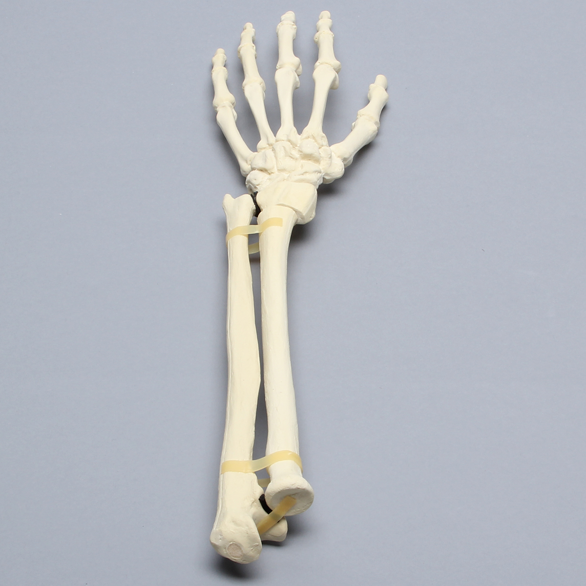 Sawbones Mano y muñeca con fractura de Colles