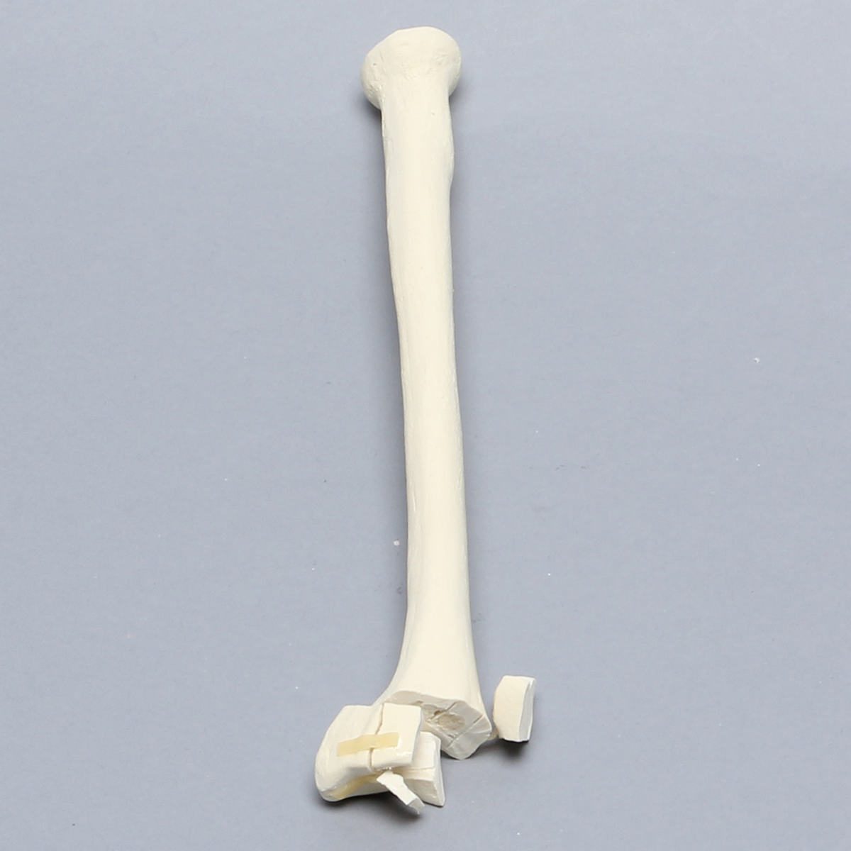 Sawbones Radio con fractura distal intraarticular en cinco partes