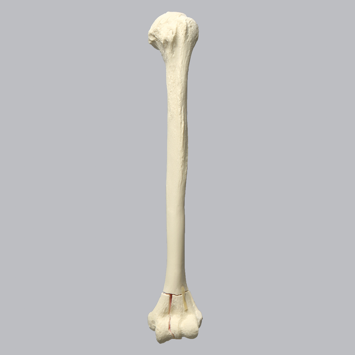 Sawbones Húmero con fractura distal en T