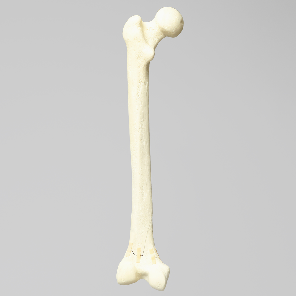 Sawbones Fémur con fractura transversal y fragmento