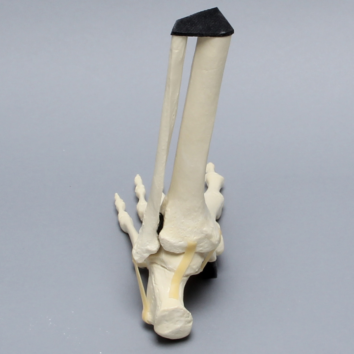 Sawbones Pie y tobillo con fractura de Lisfranc
