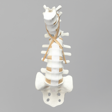 Sawbones Columna lumbar con fractura por estallido de L1