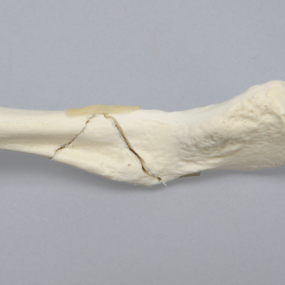Sawbones Clavícula con fractura en ala de mariposa