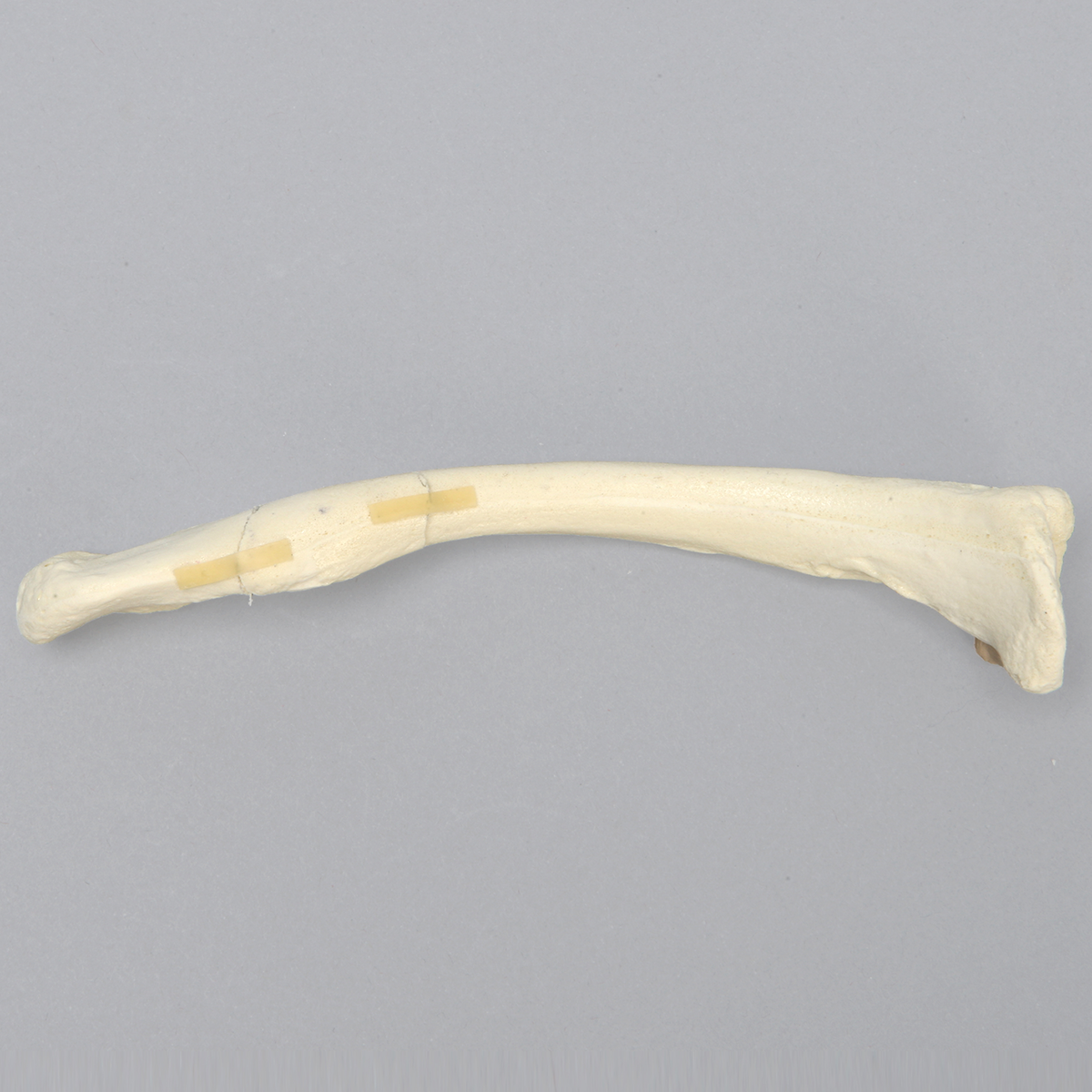 Sawbones Clavícula con fractura en ala de mariposa