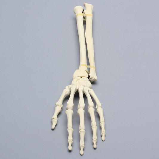 Sawbones Mano y muñeca con fractura de Colles