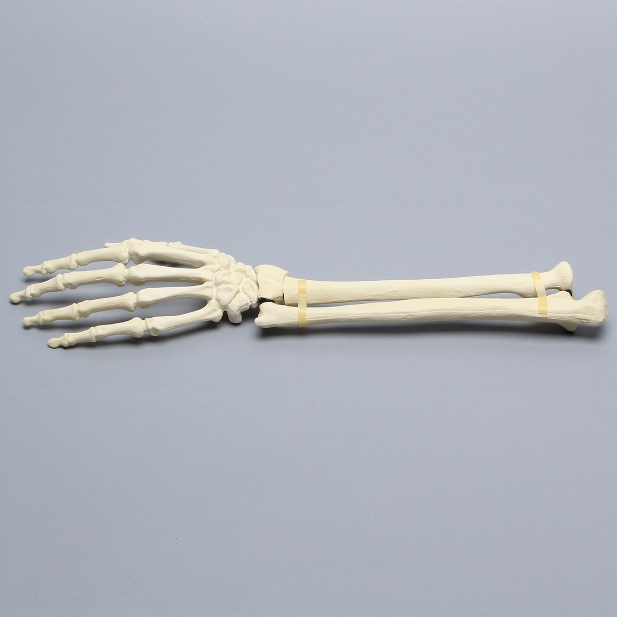 Sawbones Mano y muñeca con fractura de Colles