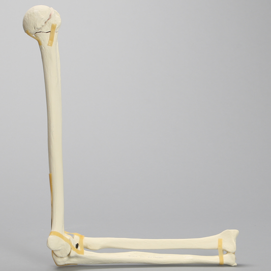 Sawbones Codo con fractura en cuatro partes