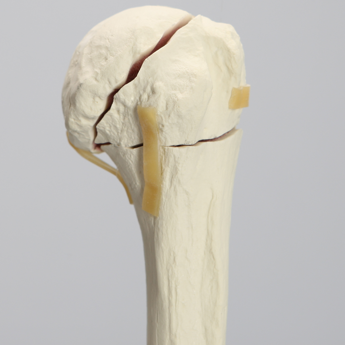 Sawbones Codo con fractura en cuatro partes
