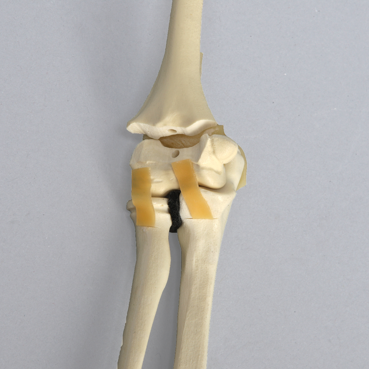 Sawbones Codo pediátrico con fractura distal
