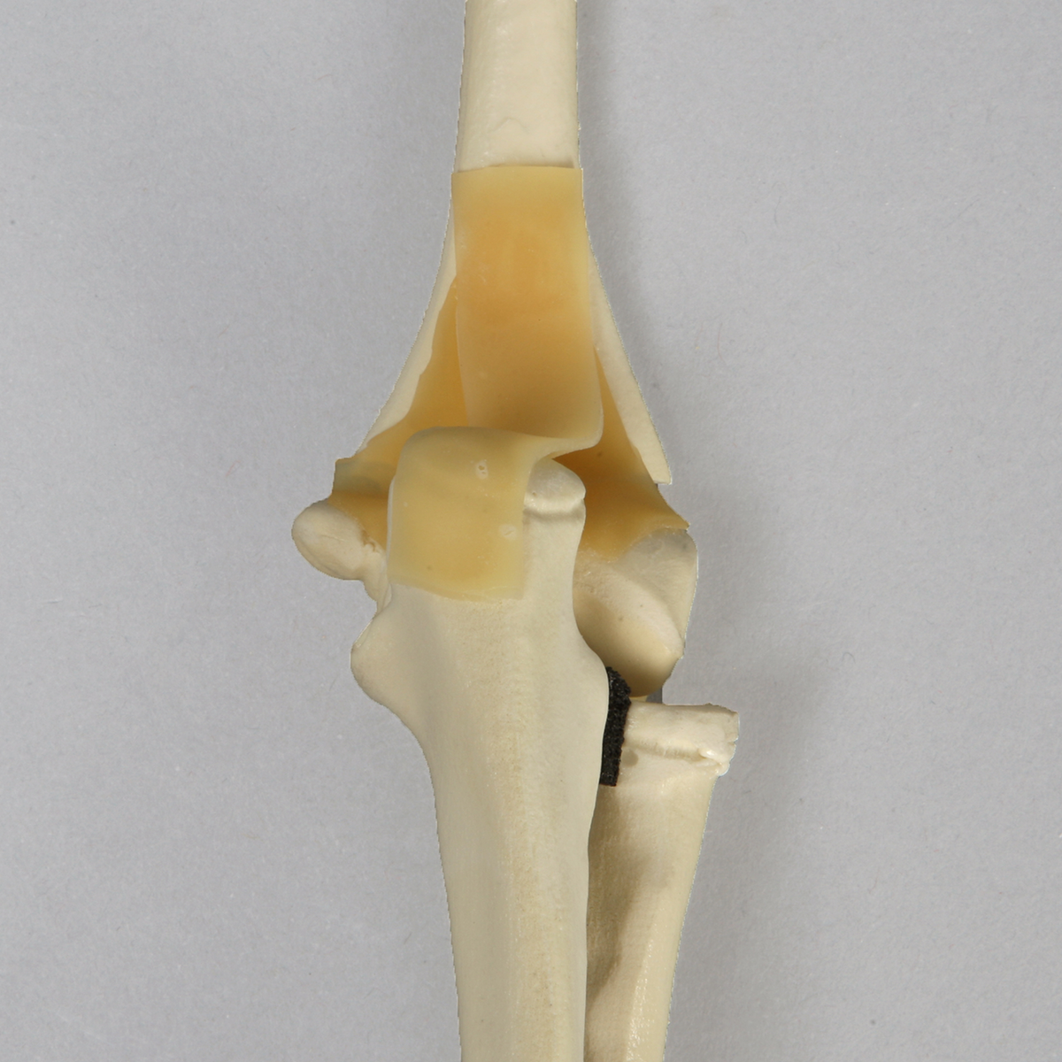 Sawbones Codo pediátrico con fractura distal