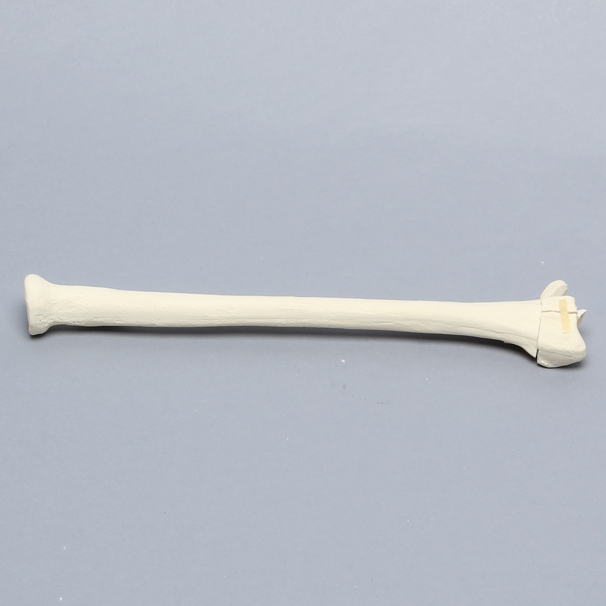 Sawbones Radio con fractura distal intraarticular en cinco partes