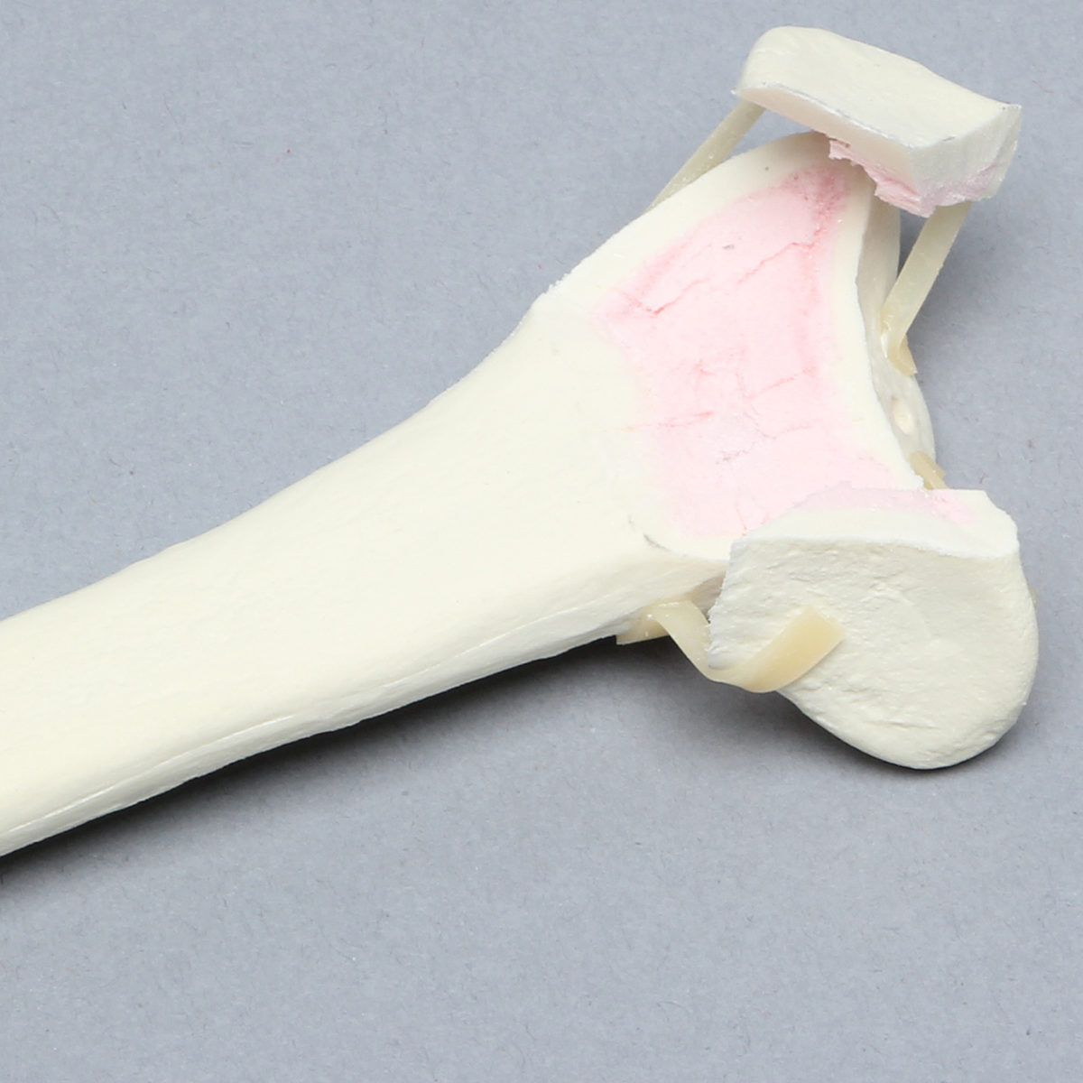 Kit Sawbones Fracturas de miembro superior