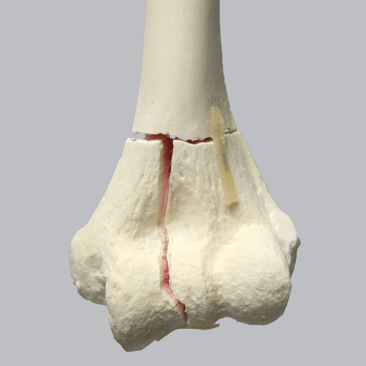 Sawbones Húmero con fractura distal en T