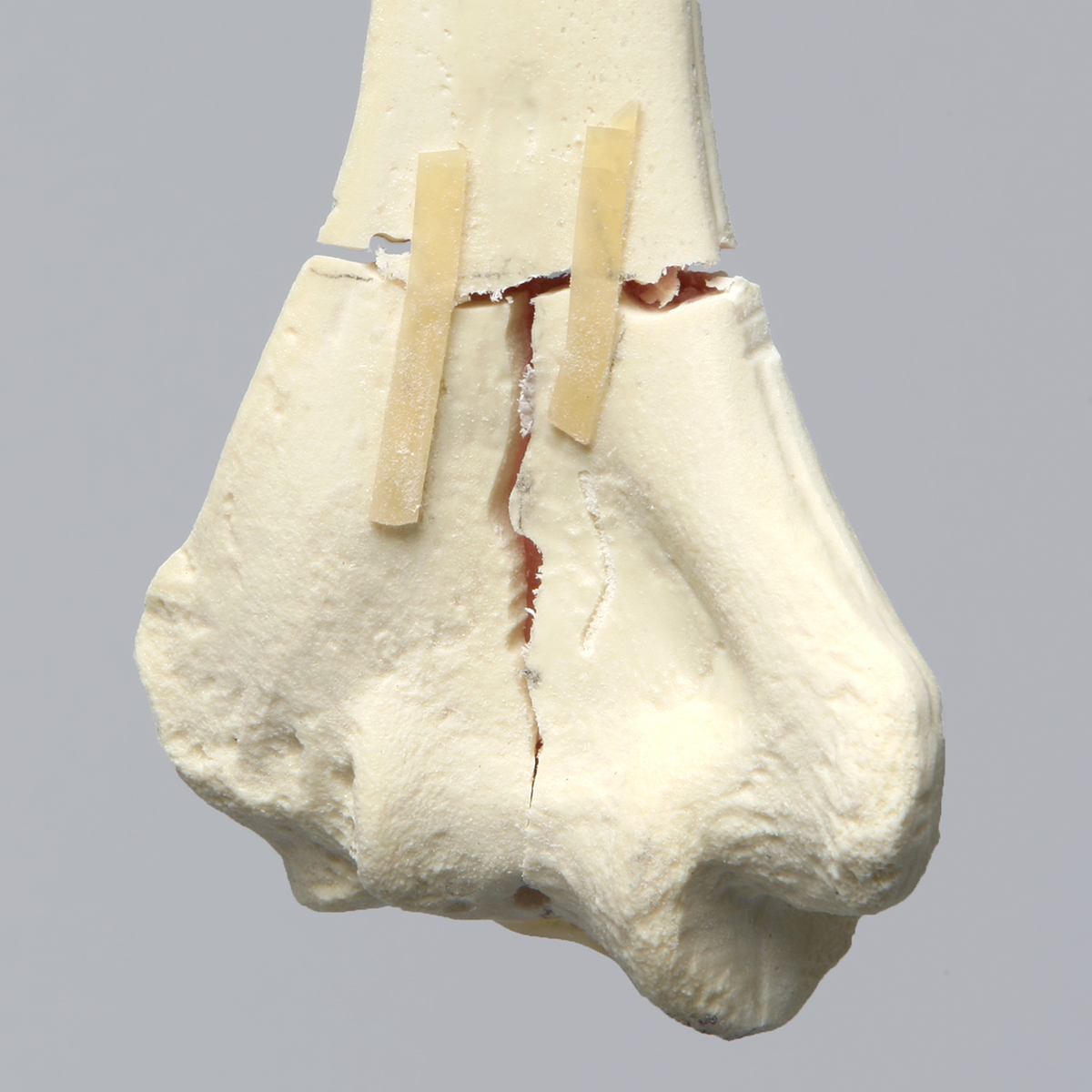 Sawbones Húmero con fractura distal en T