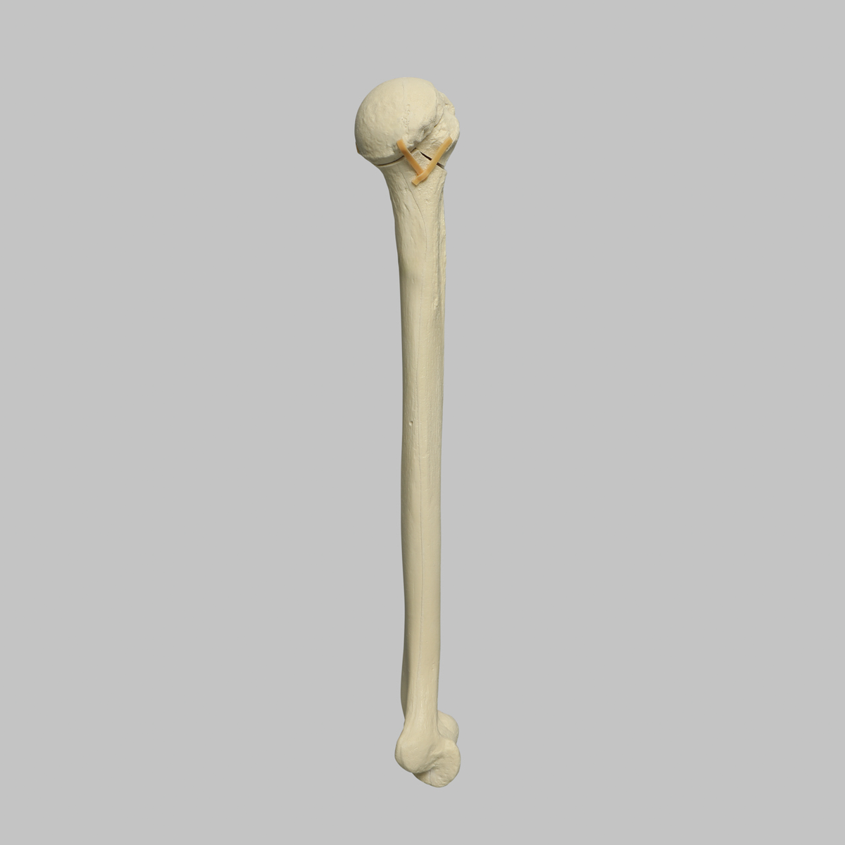 Sawbones Húmero con fractura de cabeza en cuatro partes