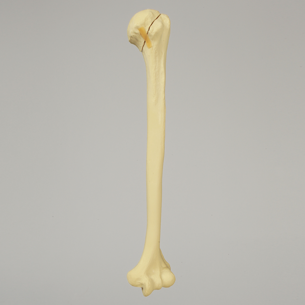 Kit Sawbones Fracturas de miembro superior