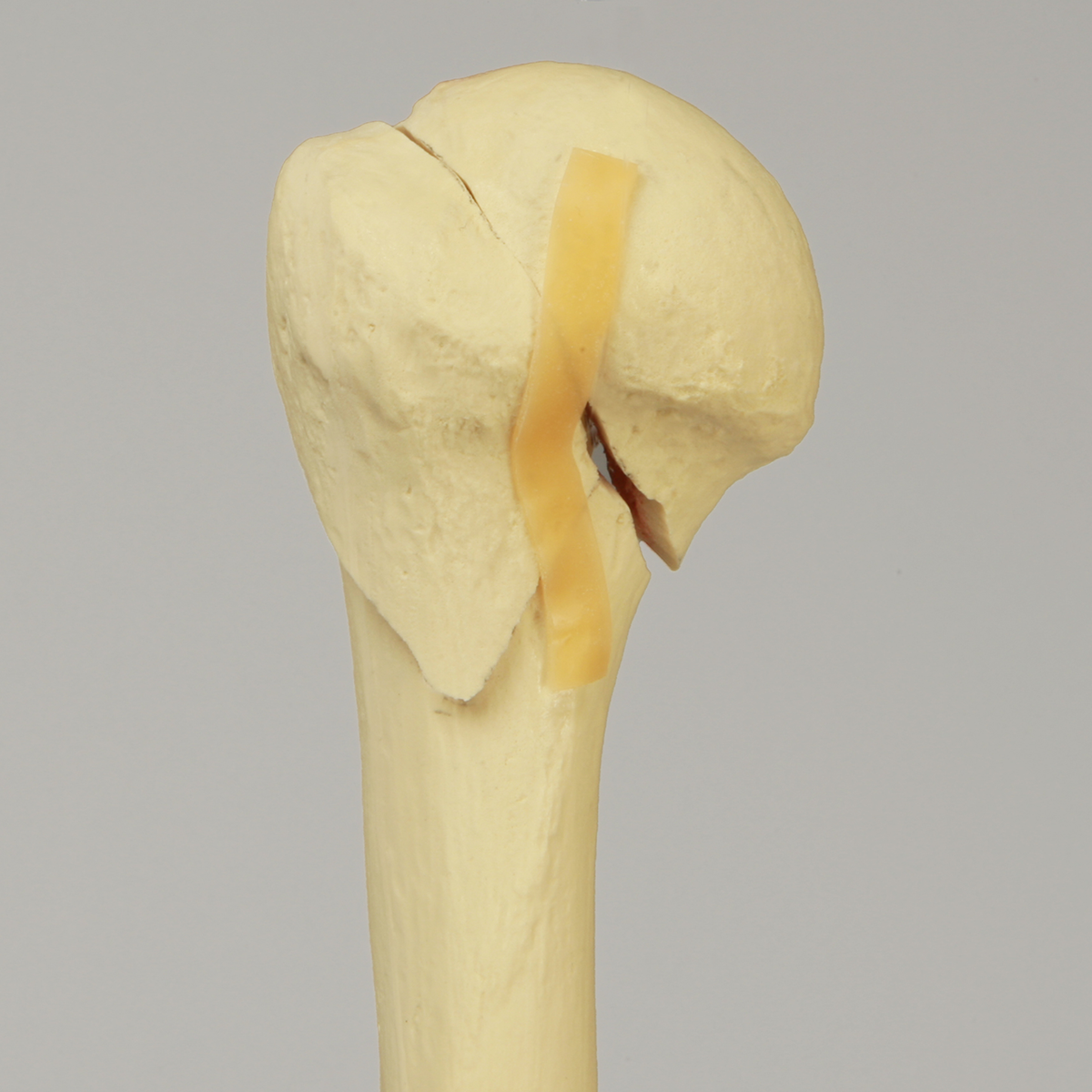 Sawbones Húmero con fractura de cabeza en tres partes