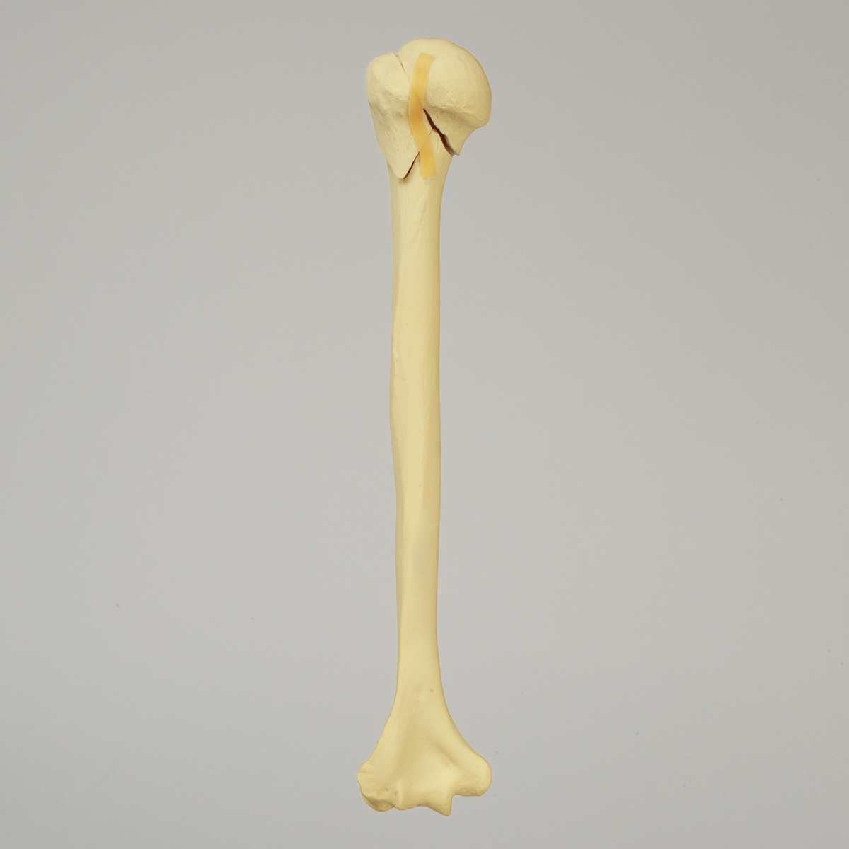 Sawbones Húmero con fractura de cabeza en tres partes