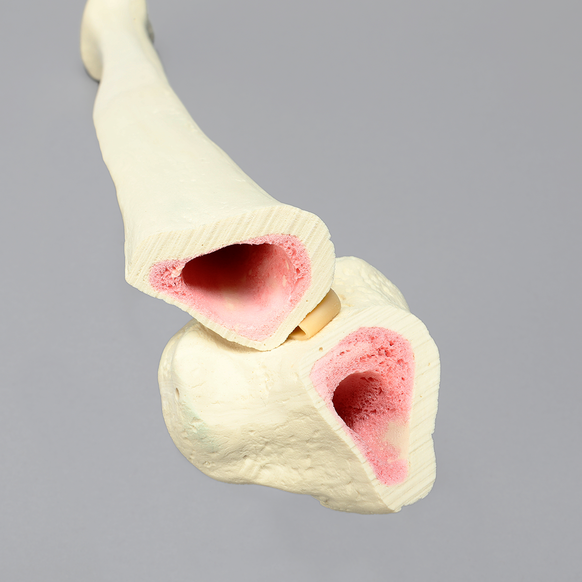 Sawbones Tibia con fractura oblicua para clavo endomedular