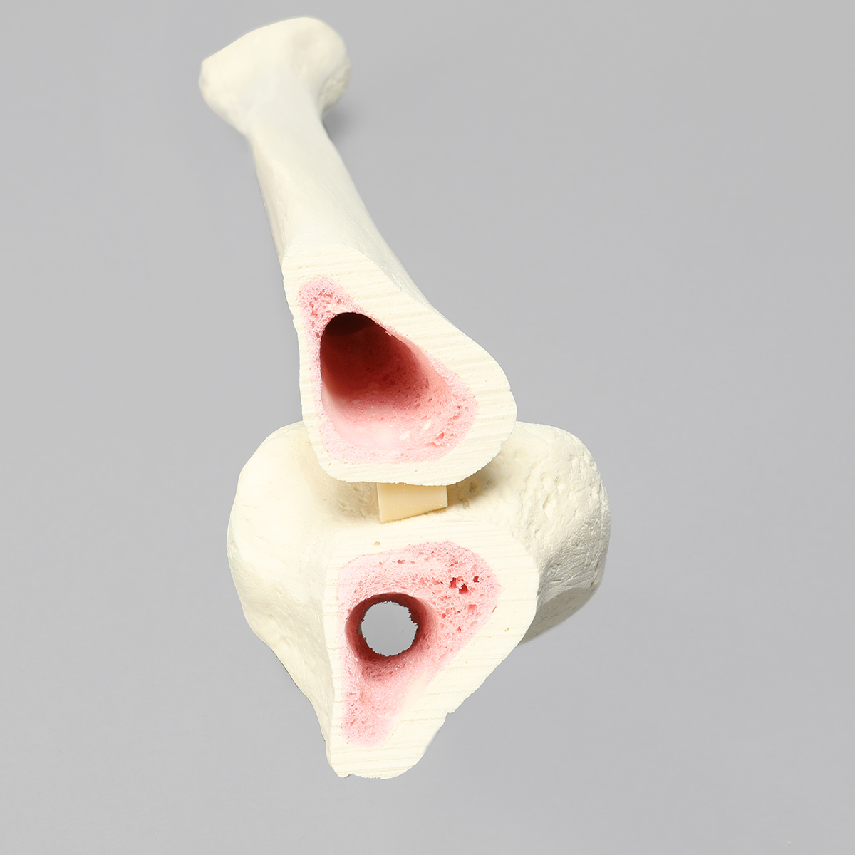 Sawbones Tibia con fractura oblicua para clavo endomedular