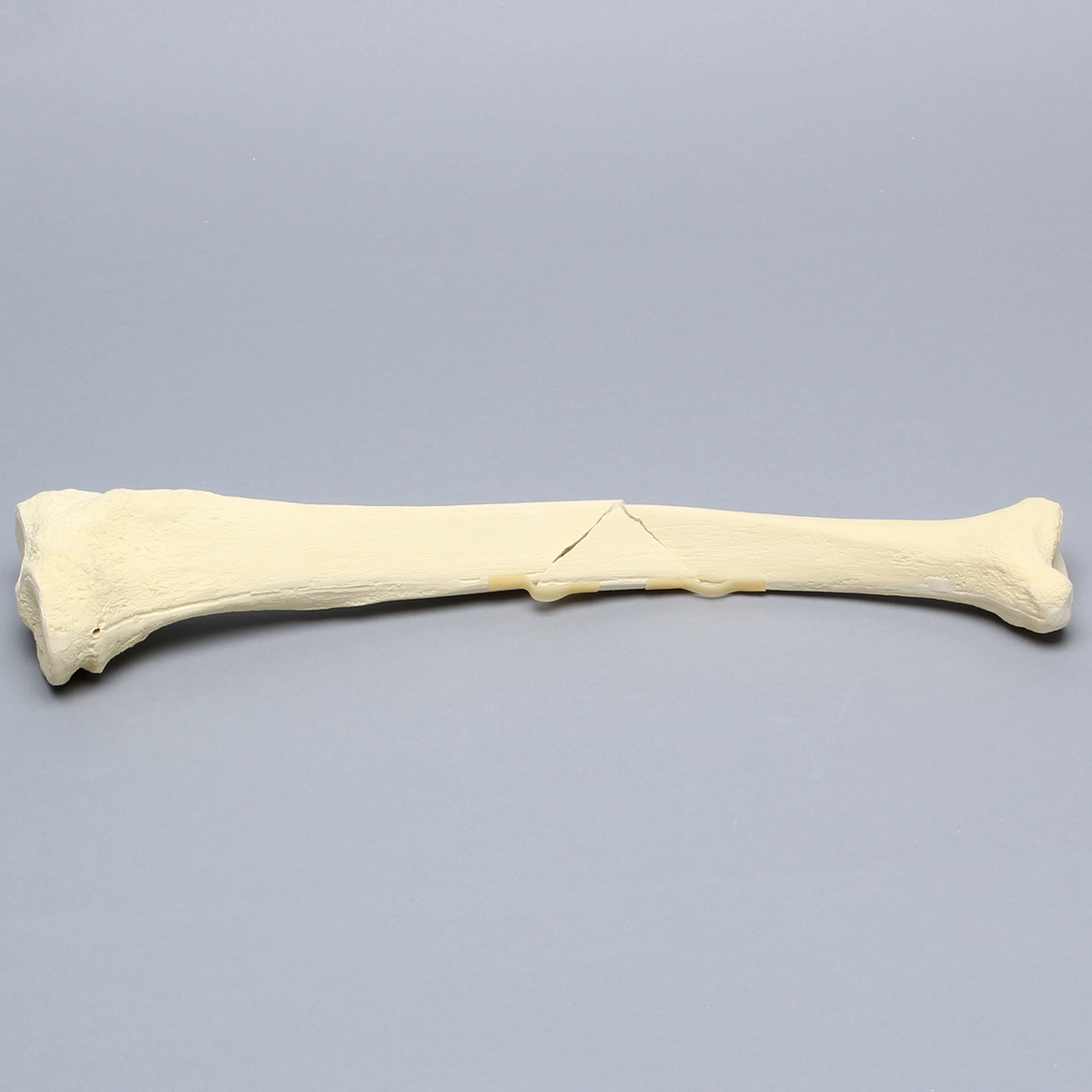 Sawbones Tibia con fractura en ala de mariposa