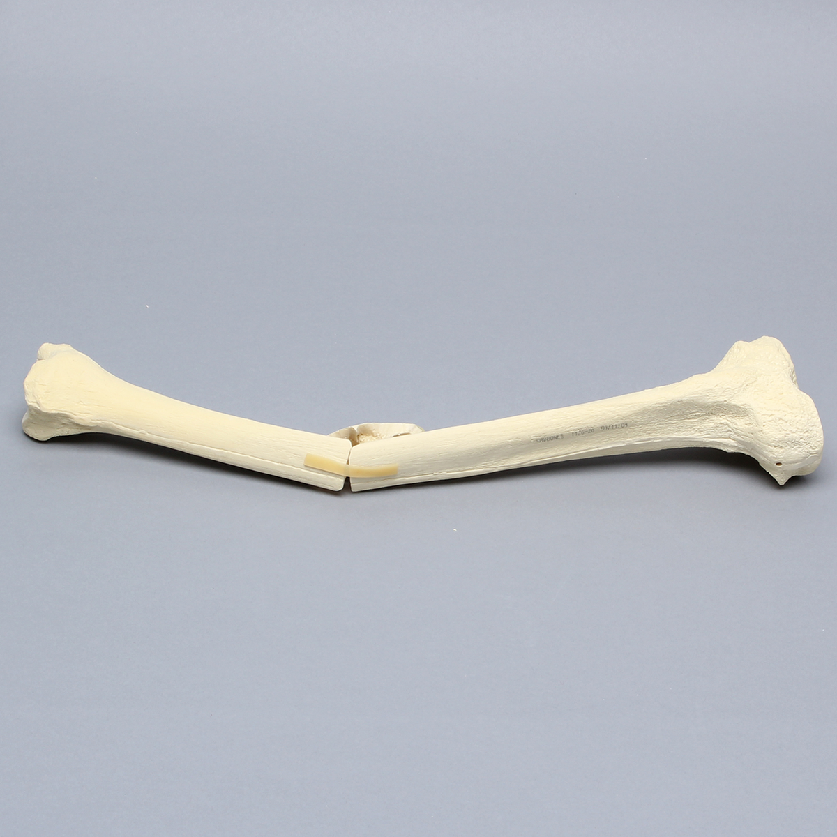 Sawbones Tibia con fractura en ala de mariposa