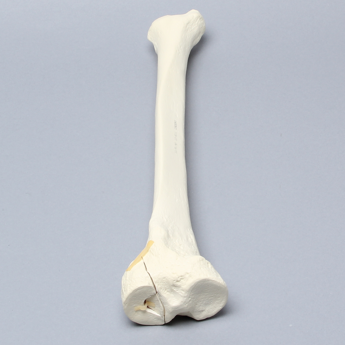 Sawbones Tibia con fractura de cóndilo lateral y hundimiento