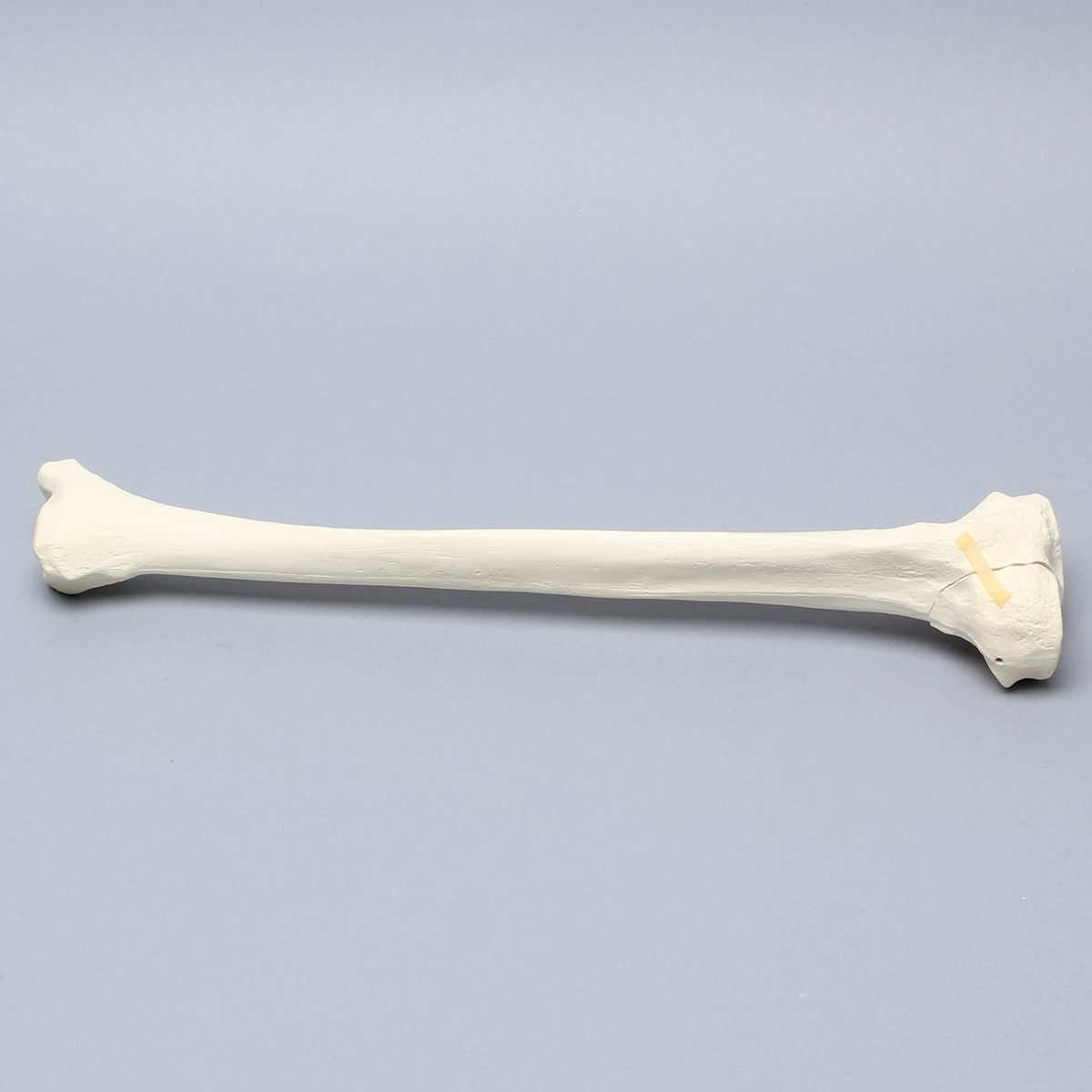Sawbones Tibia con fractura de cóndilo lateral y hundimiento