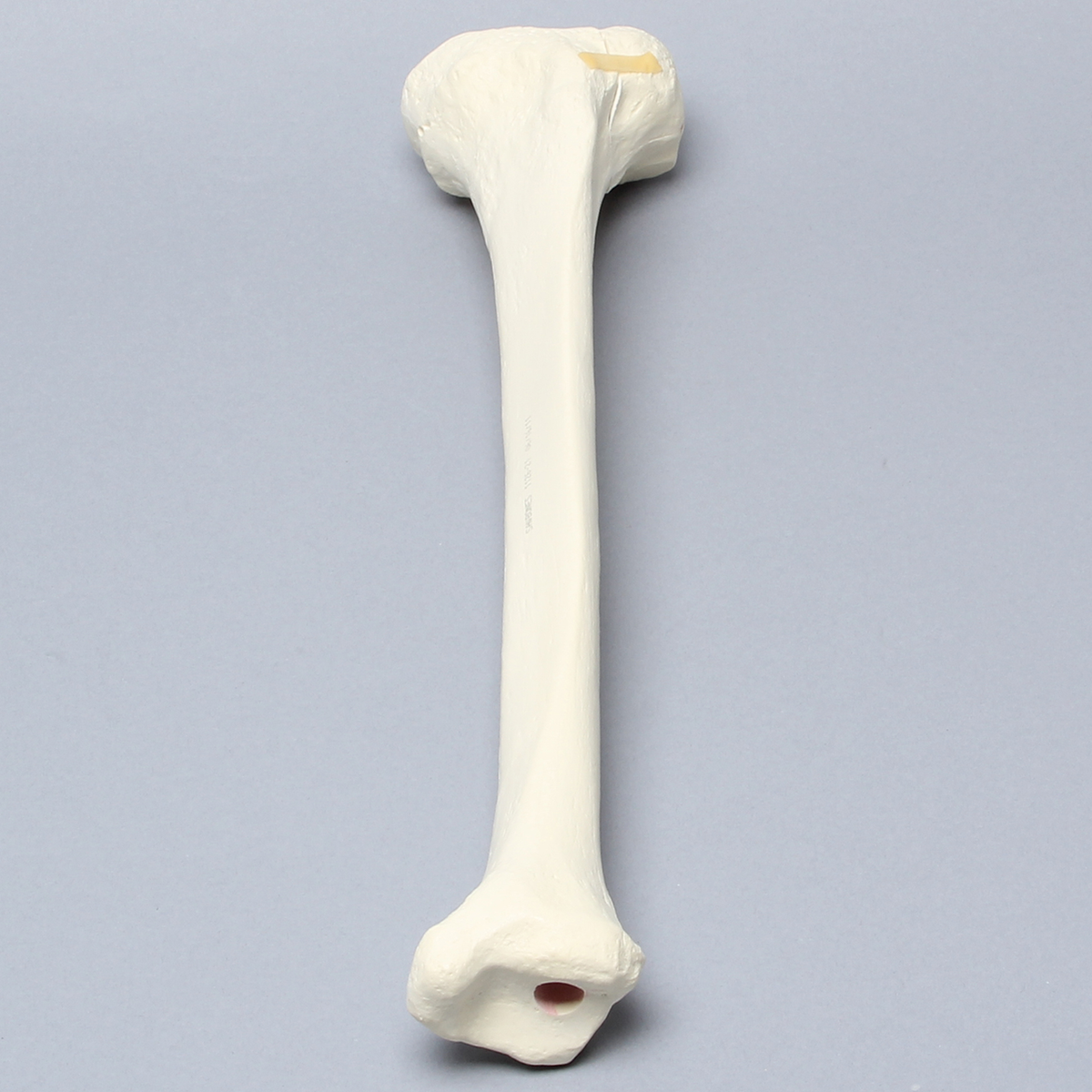 Sawbones Tibia con fractura de cóndilo lateral y hundimiento