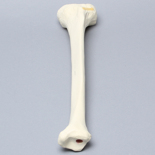 Sawbones Tibia con fractura de cóndilo lateral y hundimiento