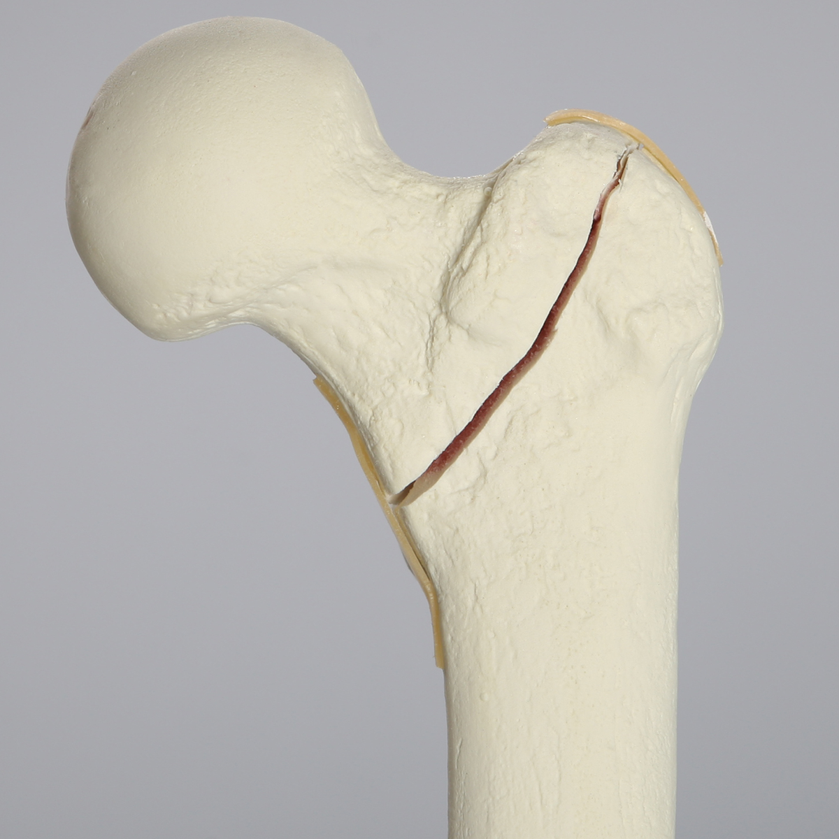 Kit Sawbones Fracturas de cadera