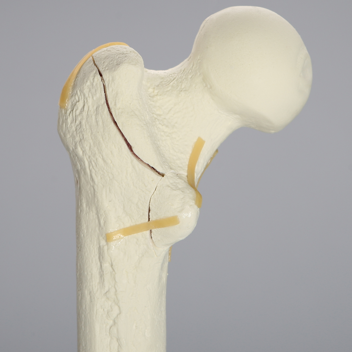 Sawbones Fémur con fractura intertrocantérica conminuta