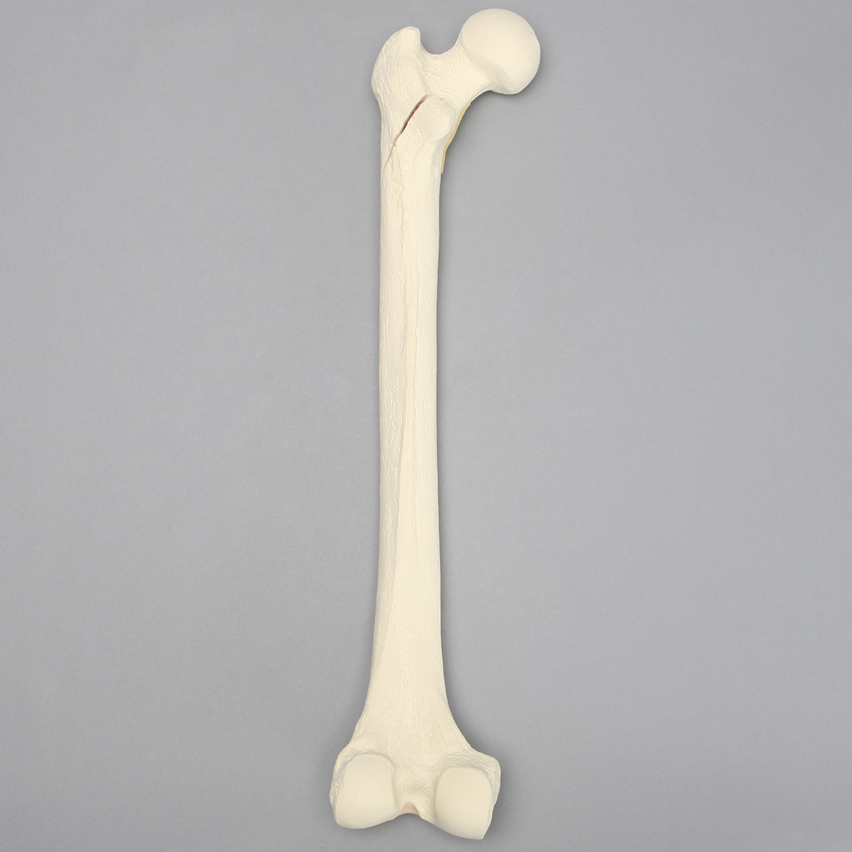 Sawbones Fémur con fractura subtrocantérica espiroidea