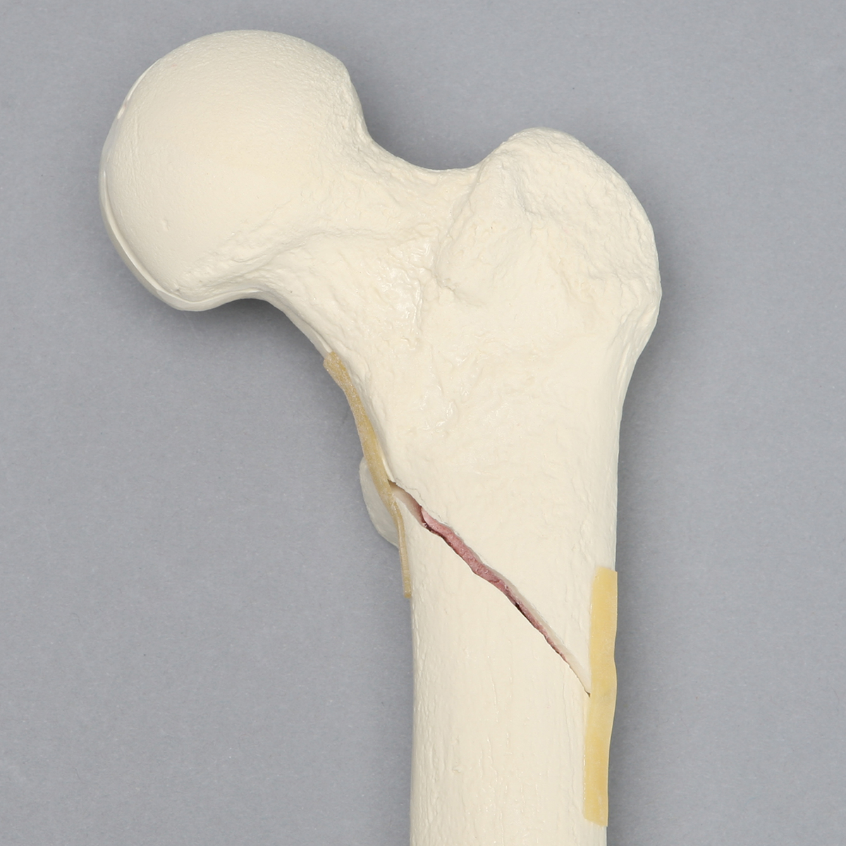 Sawbones Fémur con fractura subtrocantérica espiroidea