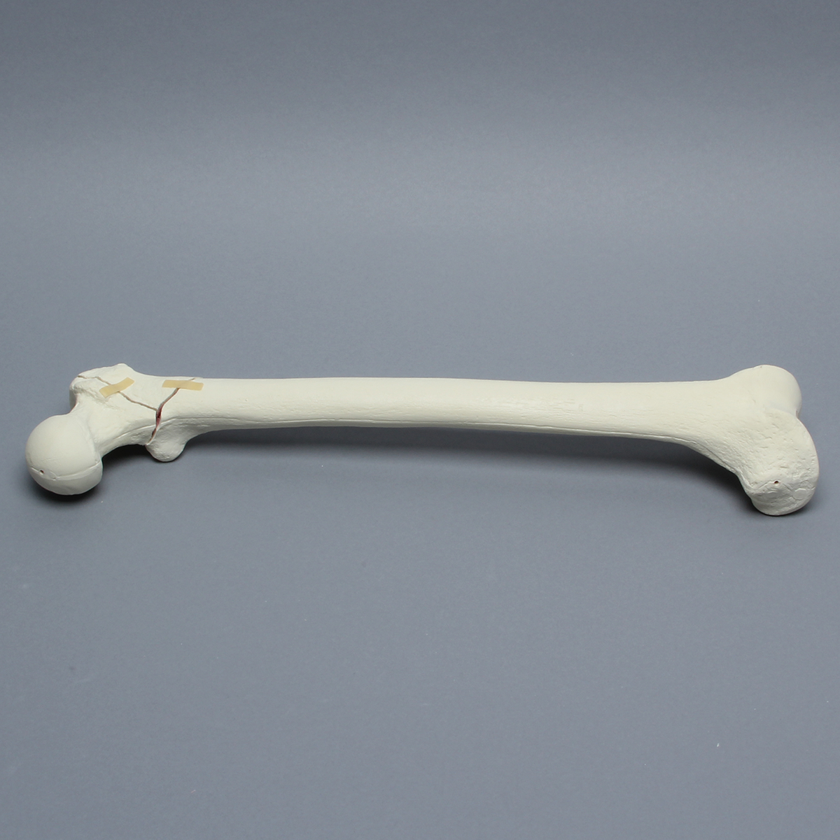 Sawbones Fémur con fractura intertrocantérica inversa en tres partes