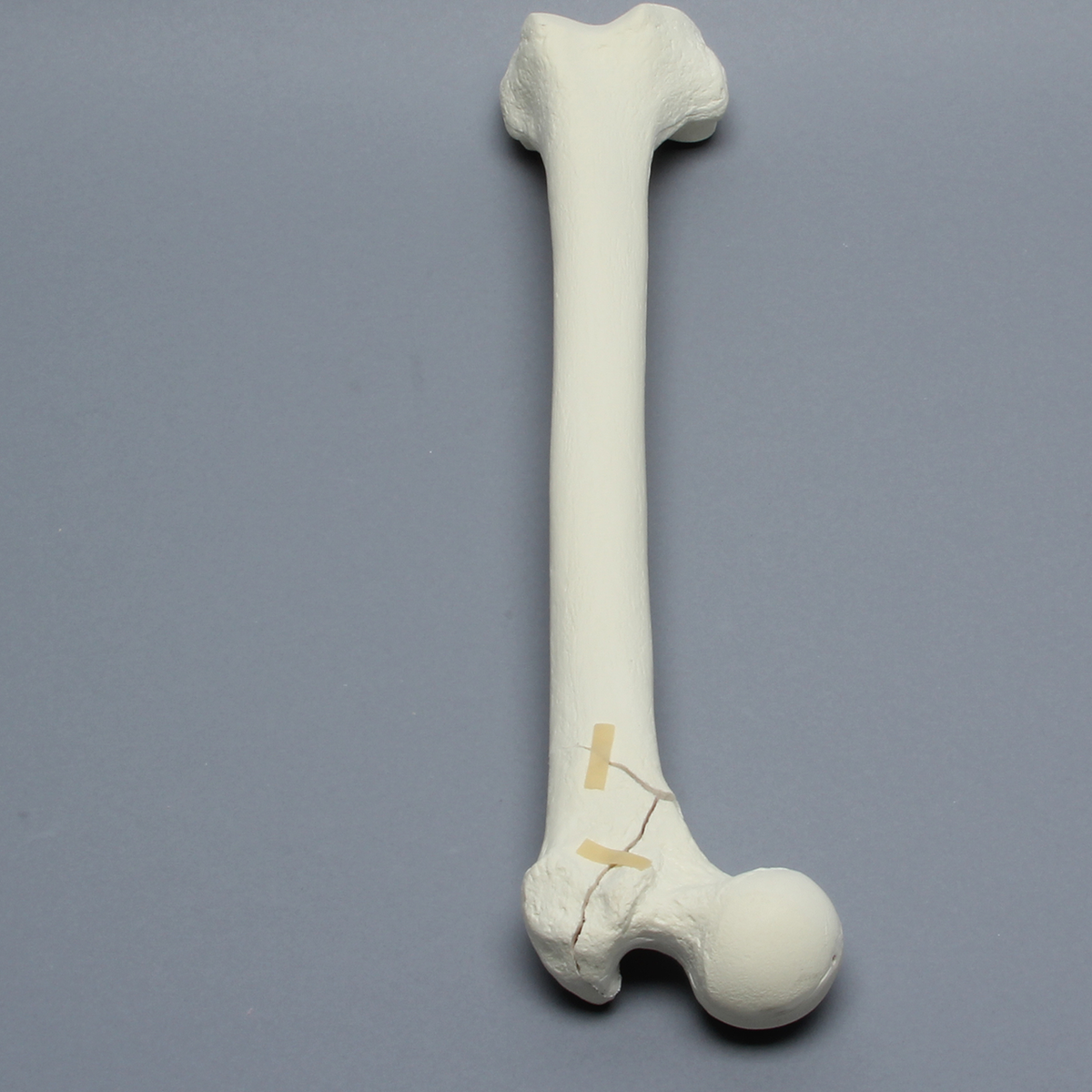 Sawbones Fémur con fractura intertrocantérica inversa en tres partes