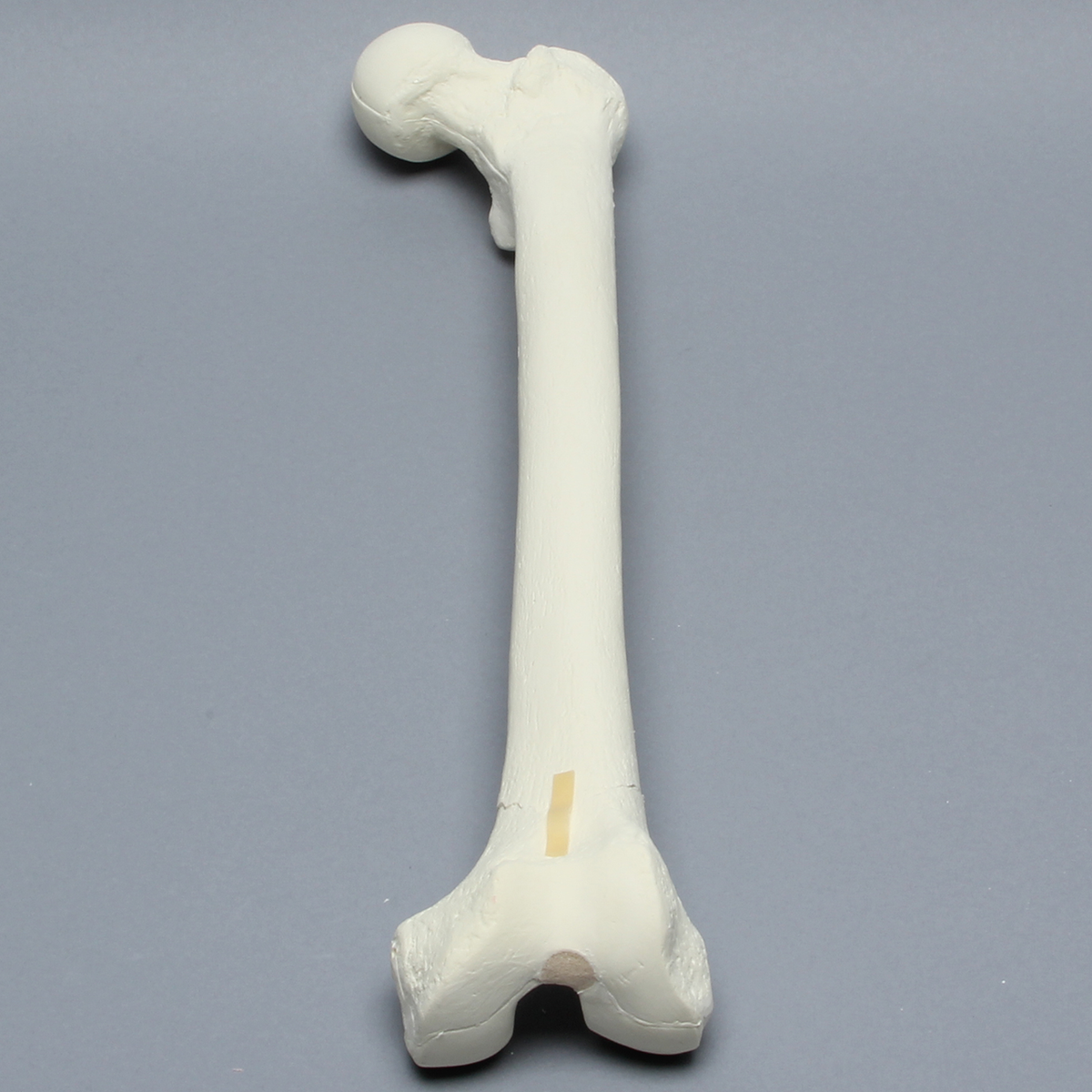 Sawbones Fémur con fractura supracondílea