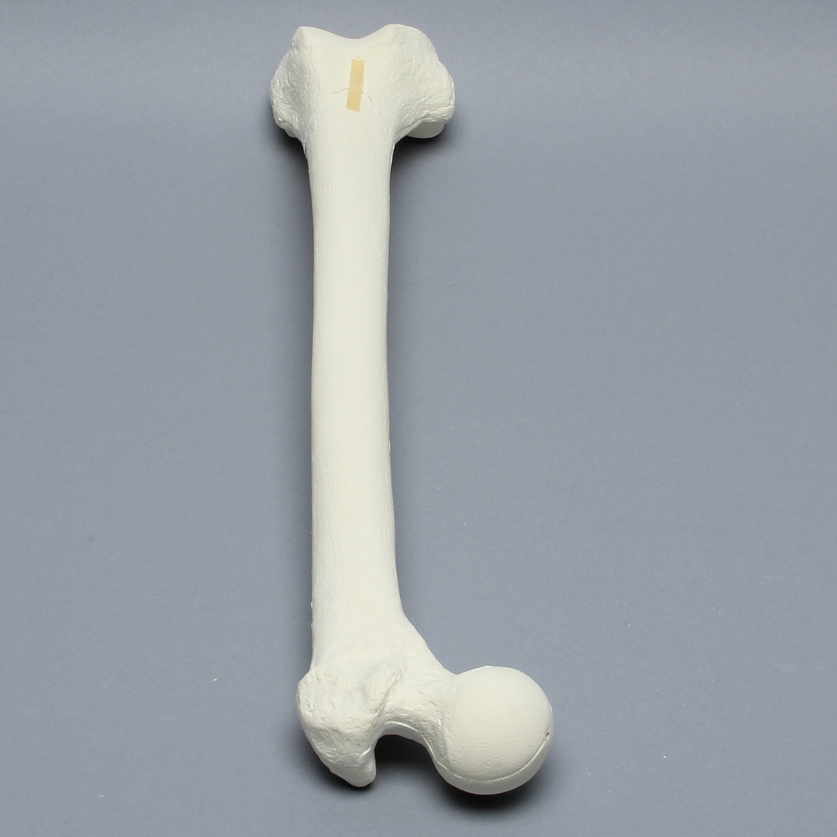 Sawbones Fémur con fractura supracondílea
