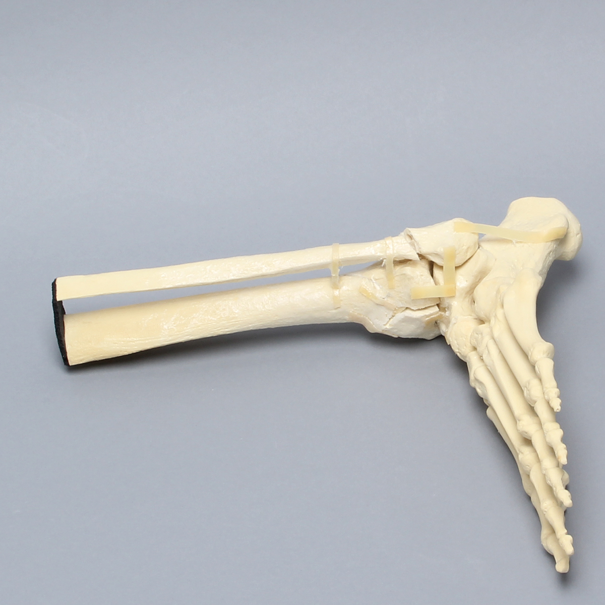Sawbones Pie y tobillo con fractura de pilón tibial y peroné