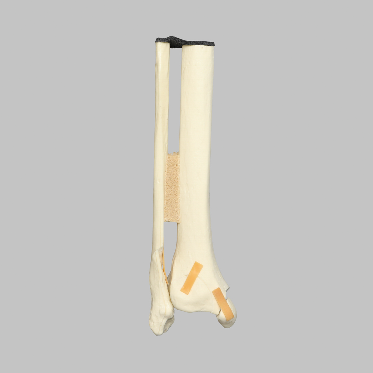 Sawbones Tobillo con fractura trimaleolar