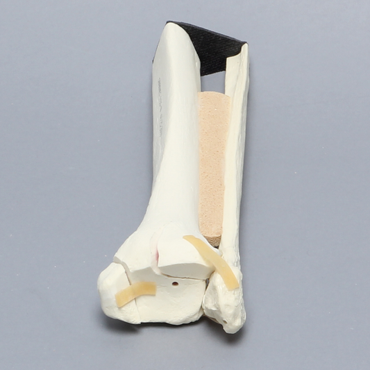 Sawbones Tobillo con fracturas maleolares Weber B