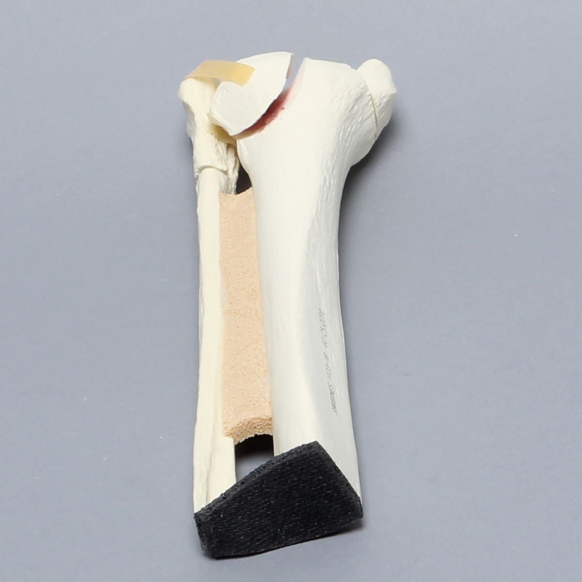 Sawbones Tobillo con fracturas maleolares Weber B