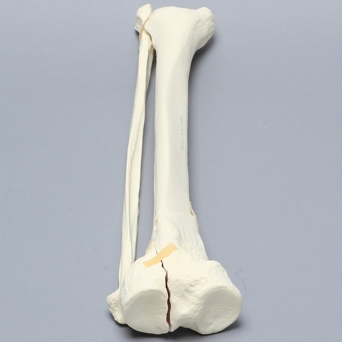 Sawbones Tibia y peroné con fractura de meseta tibial Schatzker VI