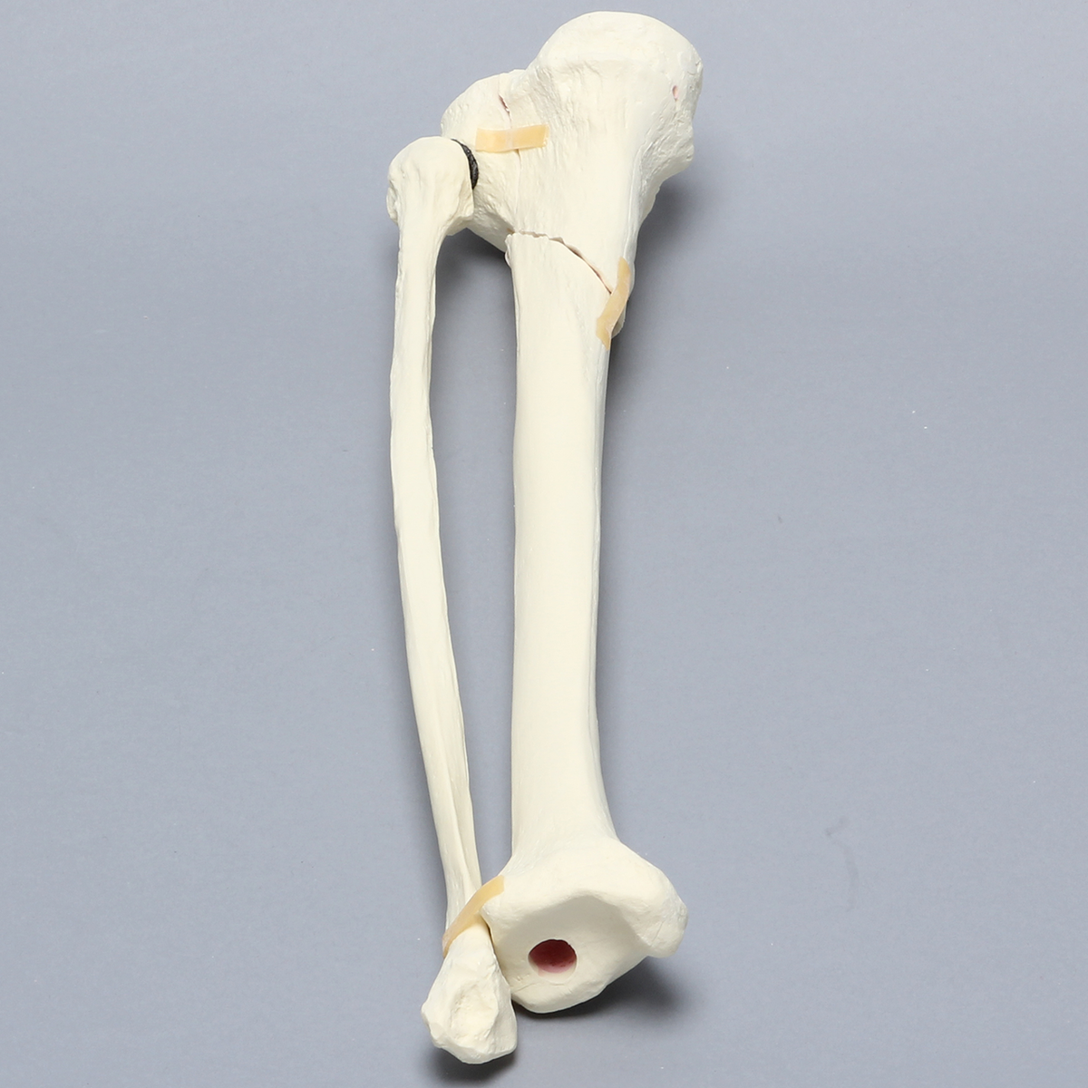Sawbones Tibia y peroné con fractura de meseta tibial Schatzker VI