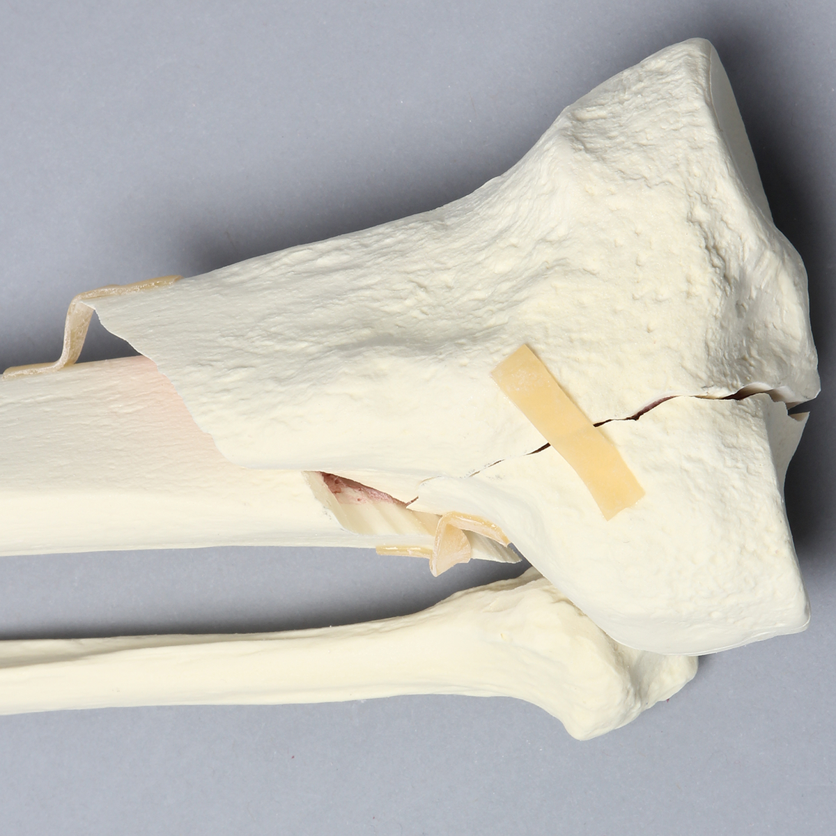 Kit Sawbones Fracturas de rodilla y meseta tibial