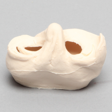 Sawbones Inserto de meniscos con lesión en colgajo, asa de balde y longitudinal