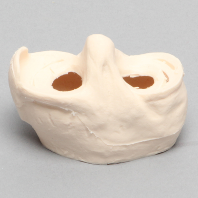 Sawbones Inserto de meniscos con lesión en colgajo, asa de balde y longitudinal