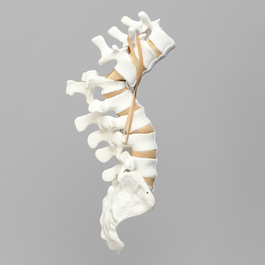 Sawbones Columna lumbar con fractura por estallido de L1