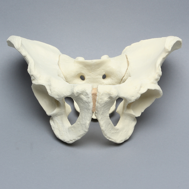 Sawbones Pelvis masculina con acetábulo artrósico